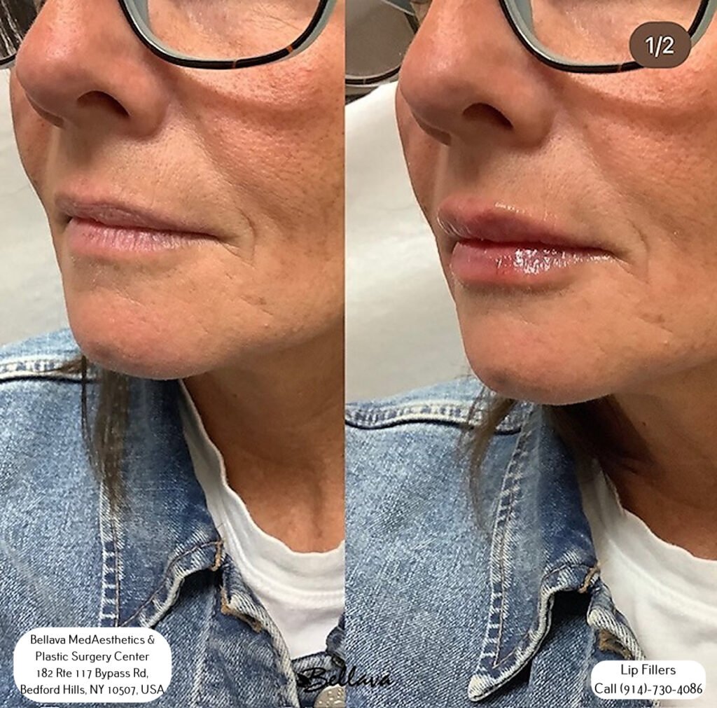 Effective Ways To Treat Cold Sores After Lip Fillers